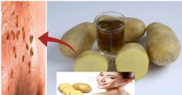 আলুতেই গায়েব ব্ল্যাকহেডস আলুতেই গায়েব ব্ল্যাকহেডস